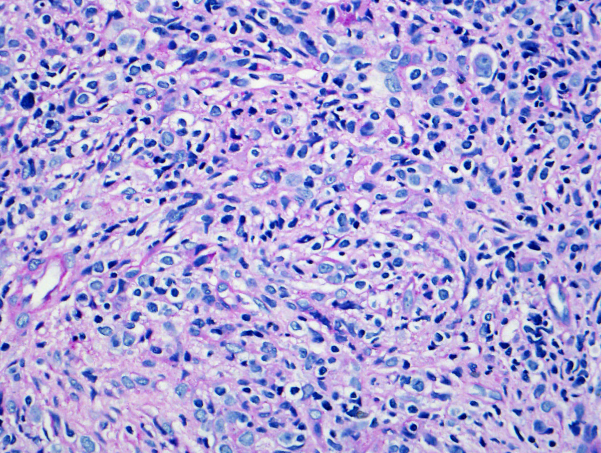 Fig.3 The marrow showed a diffuse increase in immature cells.